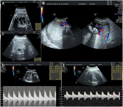 Managing two cases of twin anemia–polycythemia sequence in monochorionic twin pregnancies